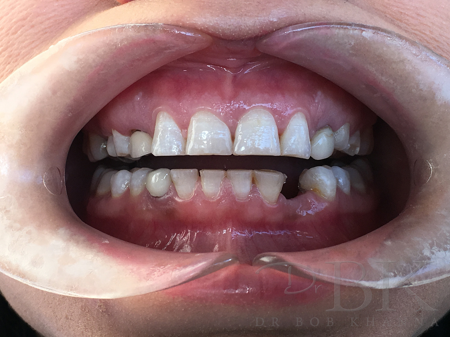 Before Full Smile Makeover at DrBK Before Full Smile Makeover at DrBK