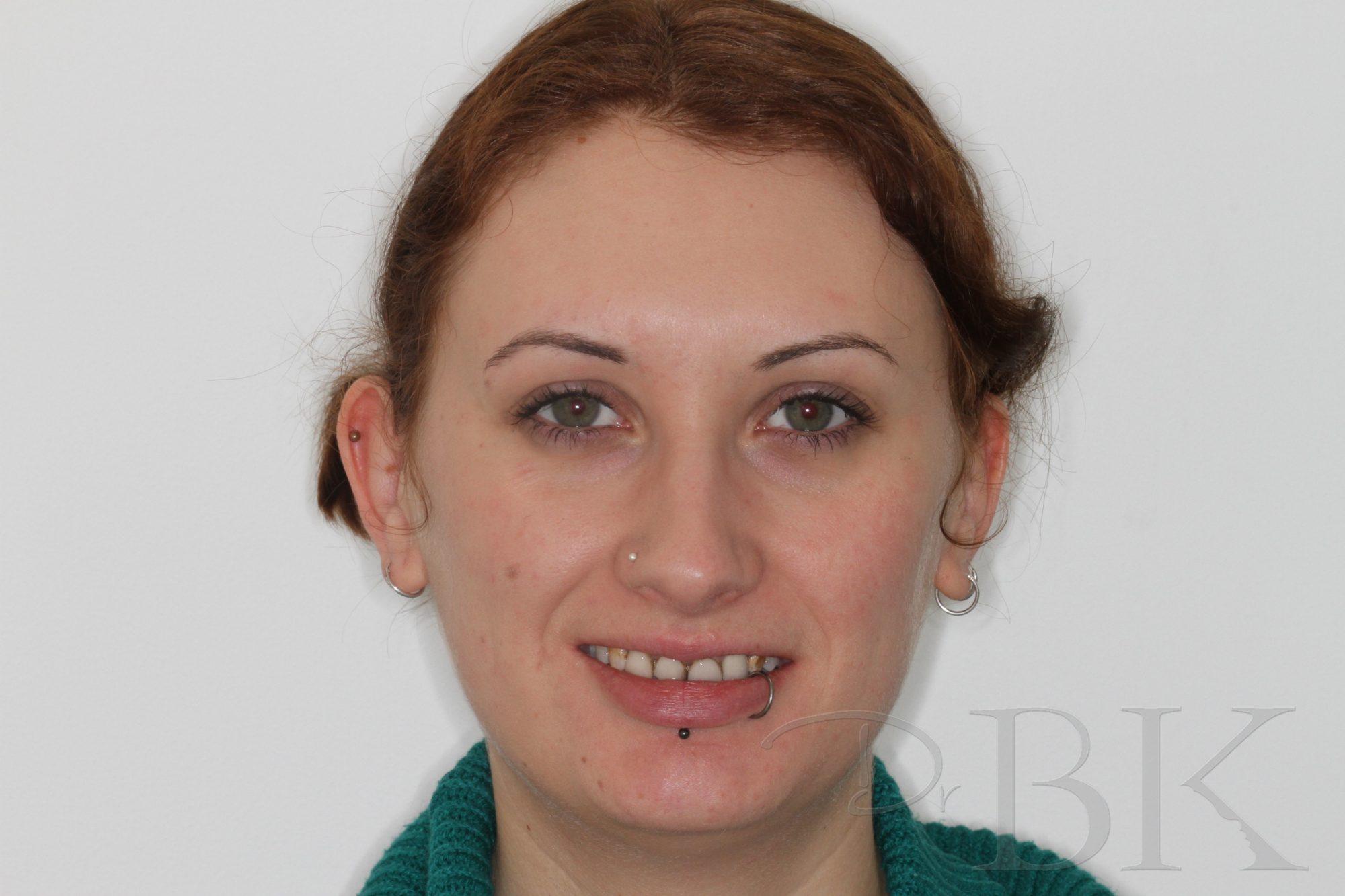 Before Full Smile Makeover at DrBK Before Full Smile Makeover at DrBK