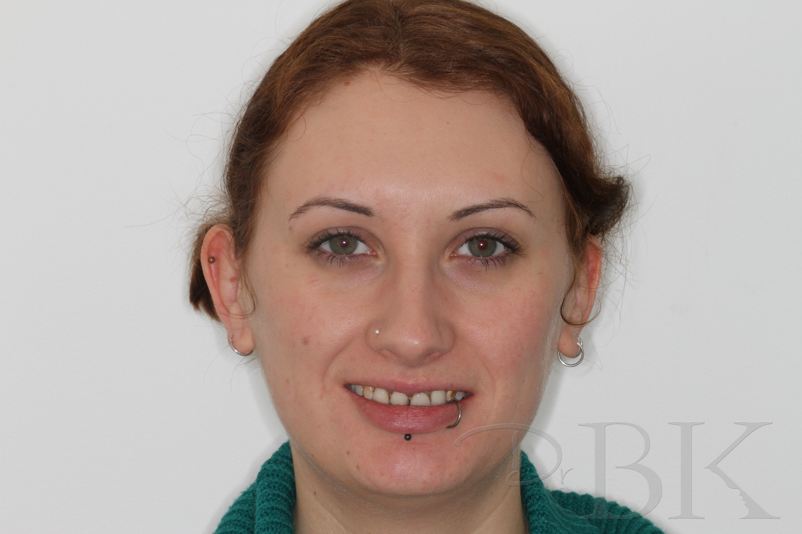 Before Full Smile Makeover at DrBK Before Full Smile Makeover at DrBK