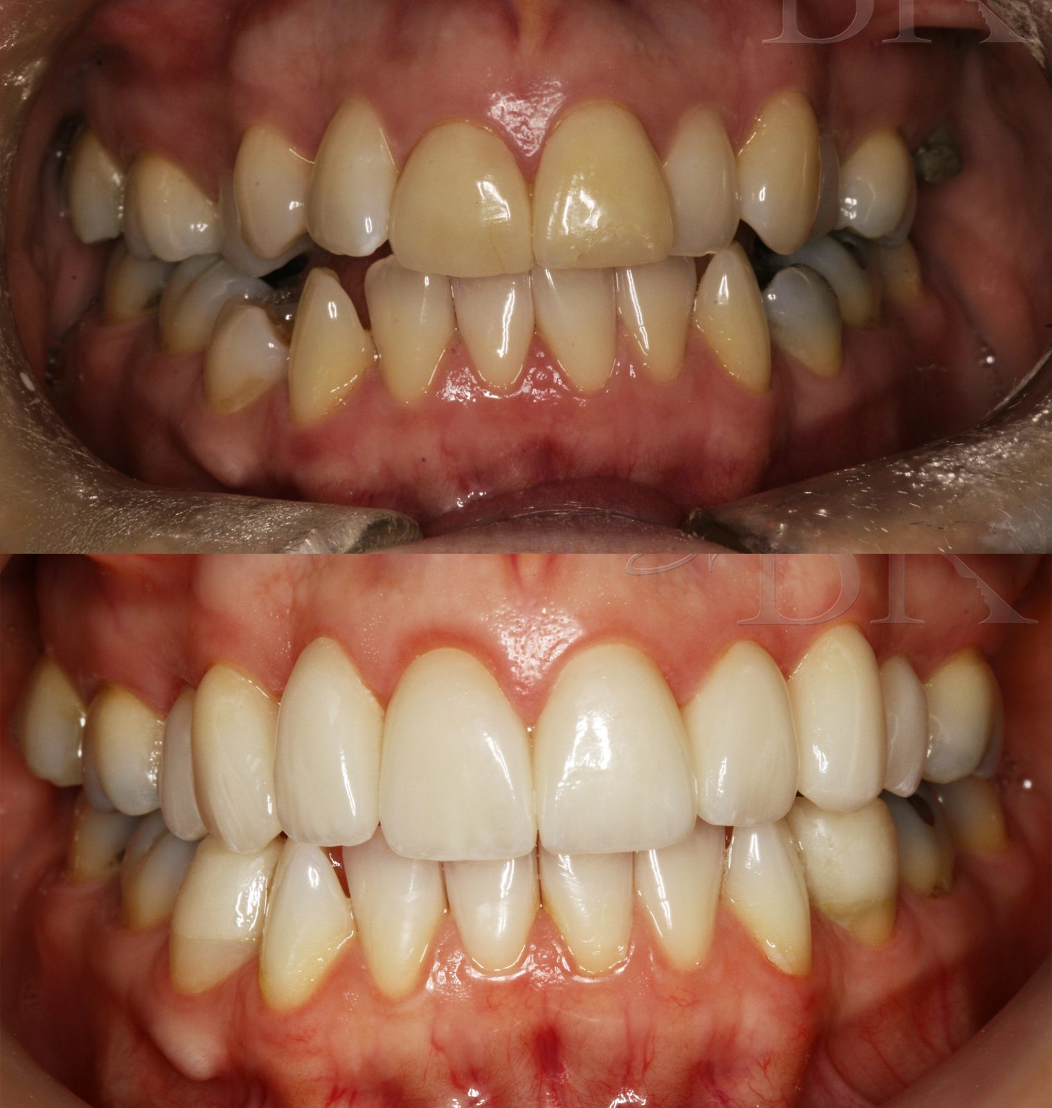 Before and After Full Smile Makeover at DrBK Before and After Full Smile Makeover at DrBK