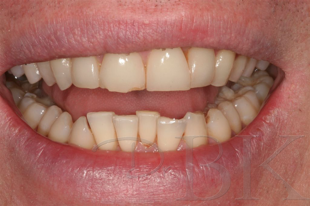 before orthodontic treatment and veneers
