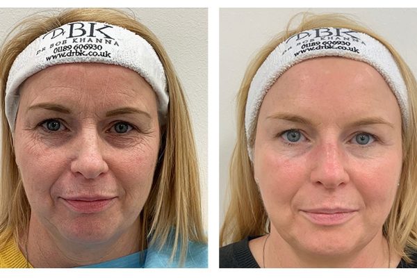 Before and After Thread Lifting Before and After Thread Lifting