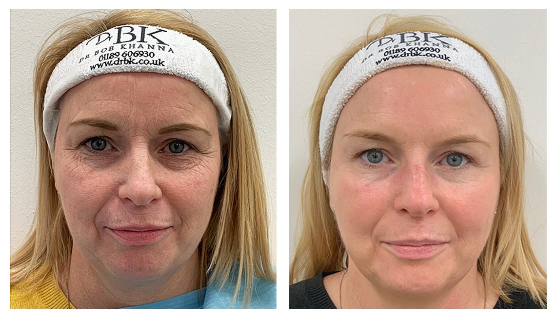 Face Lift Threading Before And After
