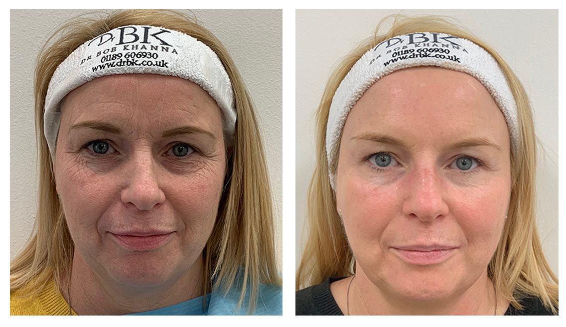 before and after thread lifting