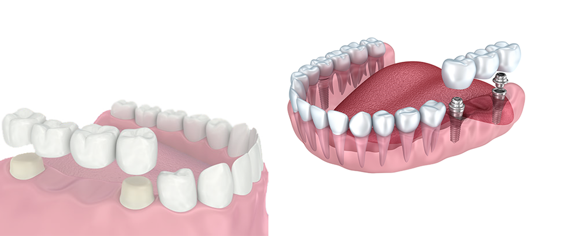 dental bridges