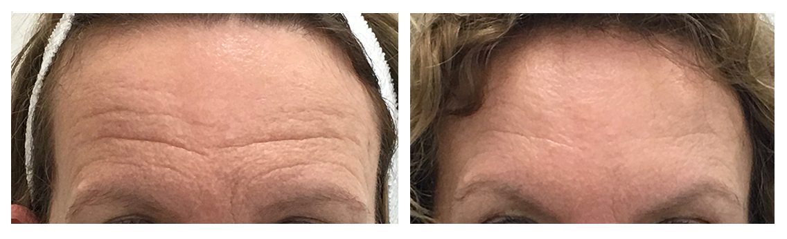 before and after brow lift - botox