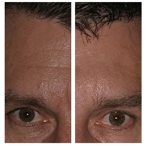 Before & After: Anti Wrinkle Treatment