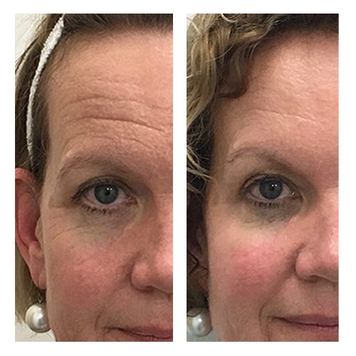 Before & After: Anti Wrinkle Treatment
