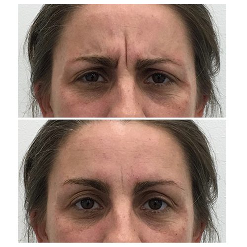Before & After: Anti Wrinkle Treatment