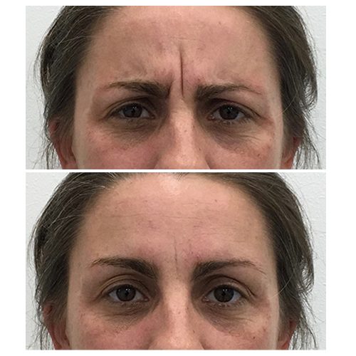 Before & After: Anti Wrinkle Treatment
