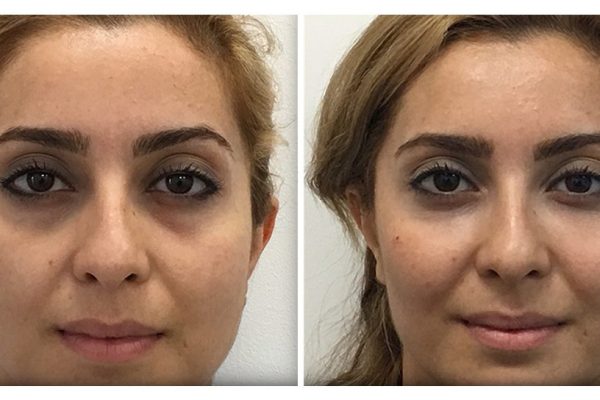 Before & After Cheek Sculpting Before & After Cheek Sculpting