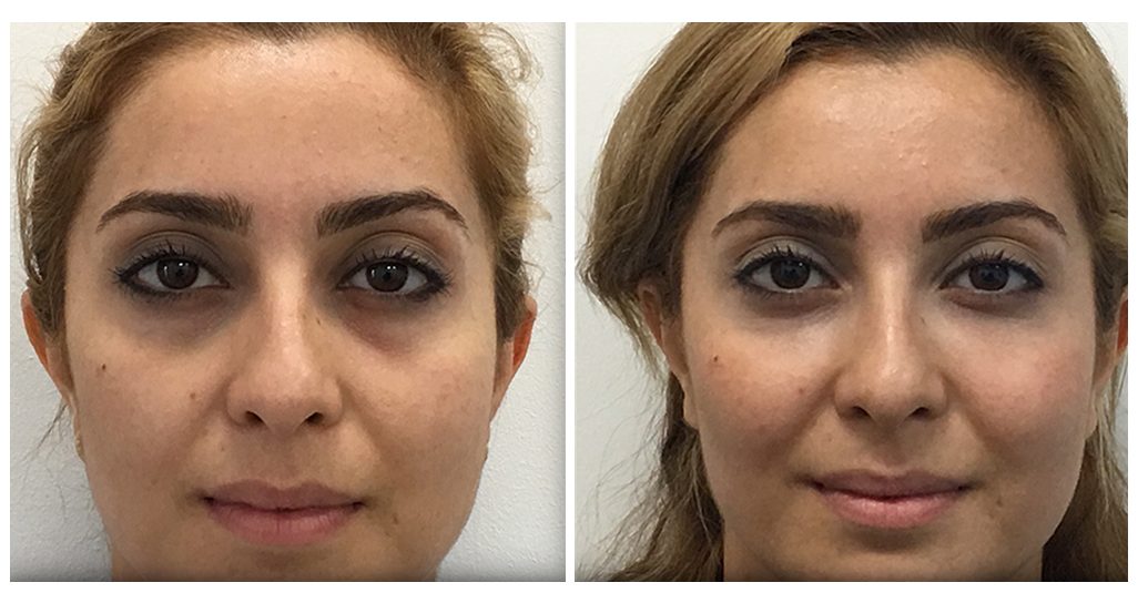 Cheek Sculpting/Filler DrBK Cosmetic Dentist & Aesthetics Clinic