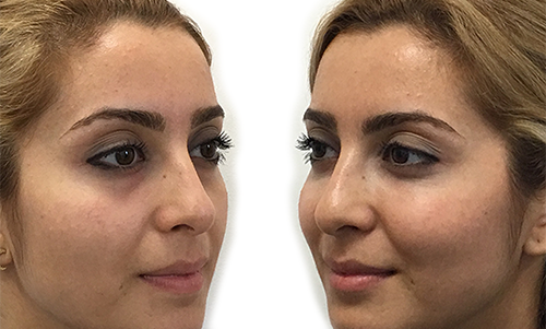 Before & After Cheek Sculpting