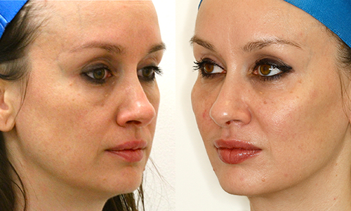 Before & After Cheek Sculpting