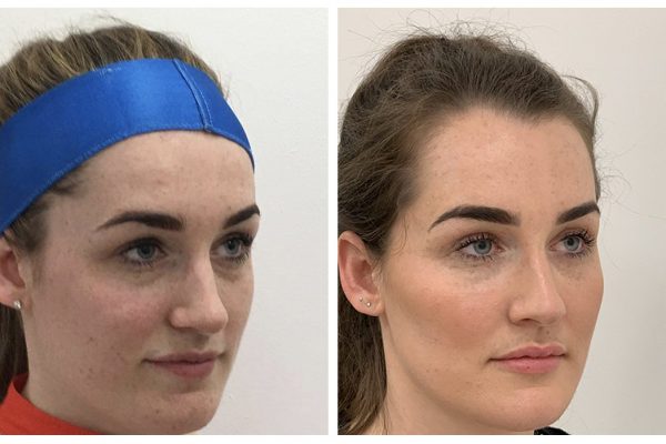 Before & After Cheek Sculpting Before & After Cheek Sculpting