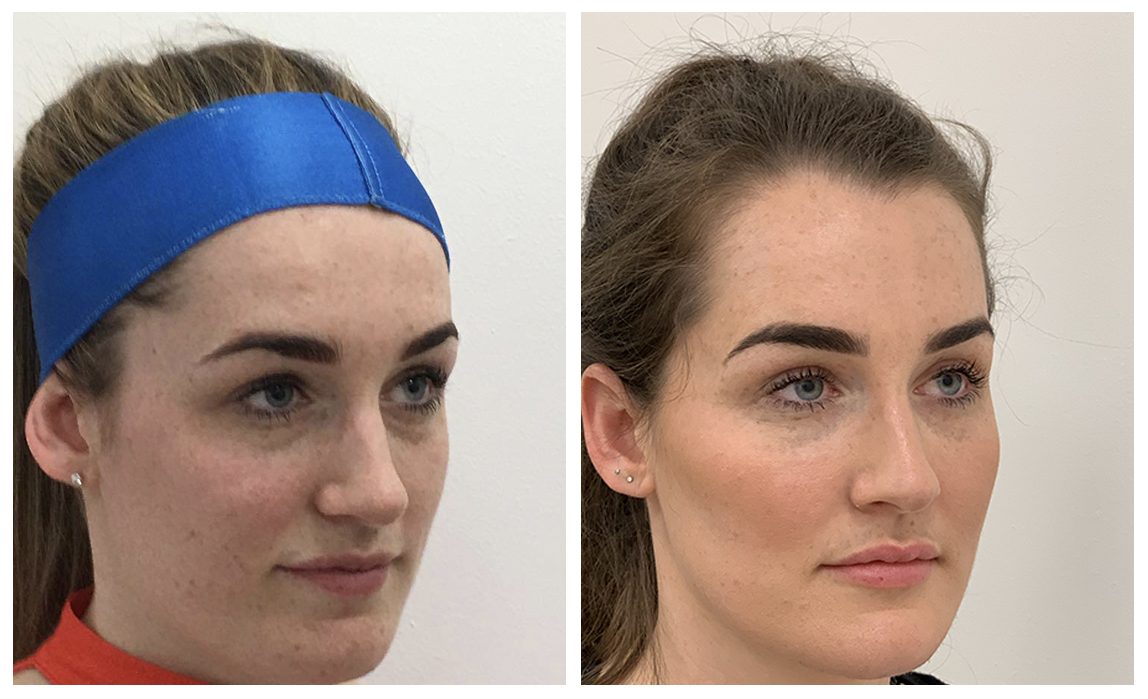 Before & After Cheek Sculpting