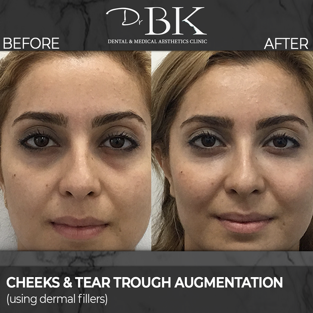 cheeksandteartroughs1