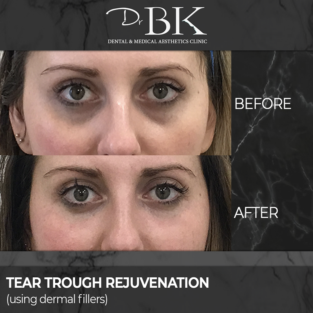 Tear trough rejuvenation