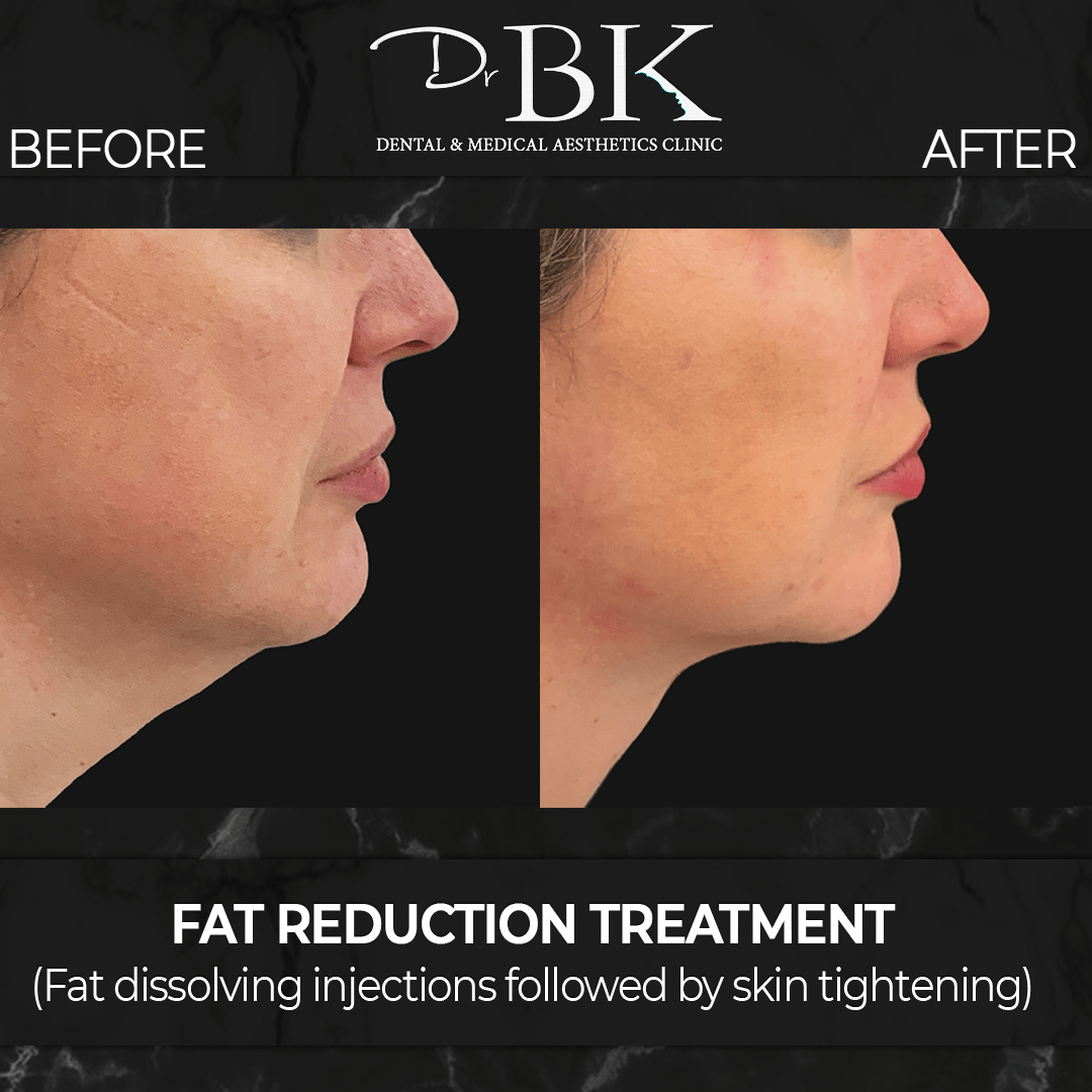 Fat Reduction & Skin Tightening at DrBK