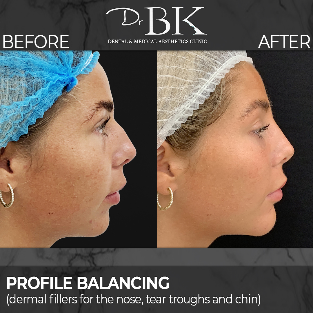 Profile Balancing: Dermal fillers for the nose, tear troughs & cheeks