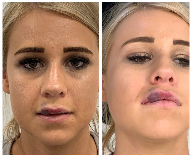 "I nearly lost my lip!" Claire's Lip Filler Nightmare Saved by DrBK