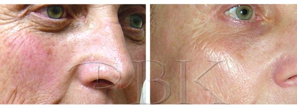 Before & After Clearlift