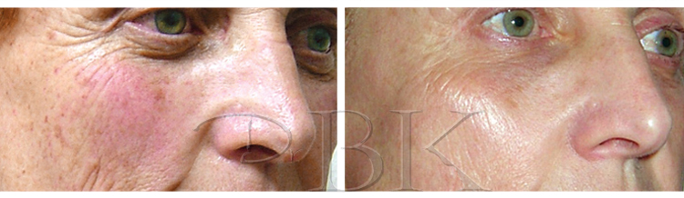 Before & After Clearlift