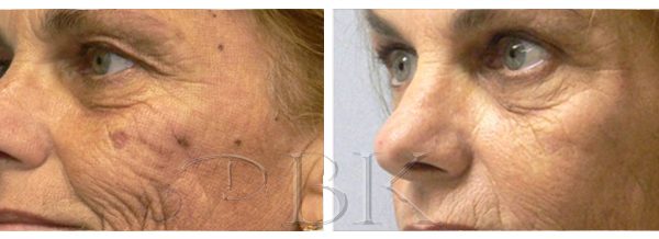 clearlift facial rejuvenation at drbk
