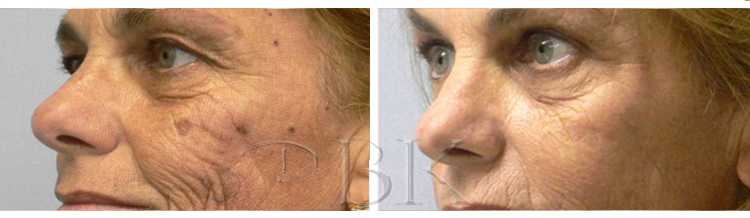clearlift facial rejuvenation at drbk