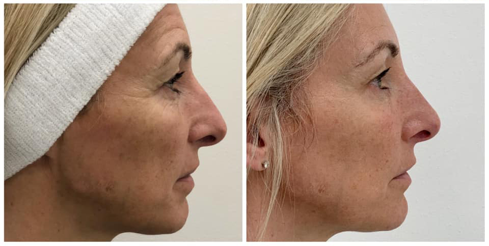 Before & After Full Face Treatment (Mild): Anti-wrinkle treatments, Cheeks & Tear Troughs, Nose, Chin & Skincare