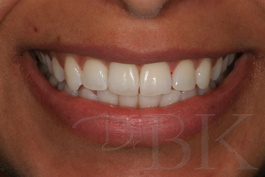 Orthodontics with Clear Aligners DrBK Cosmetic Dentist & Aesthetics