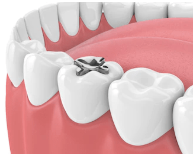 Dental Inlays DrBK Cosmetic Dentist & Aesthetics Clinic in Reading