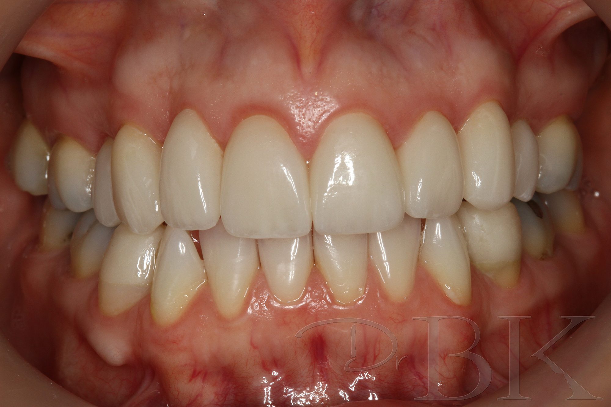 After Veneers dental veneers dentist reading VENEERS P1 AFTER copy