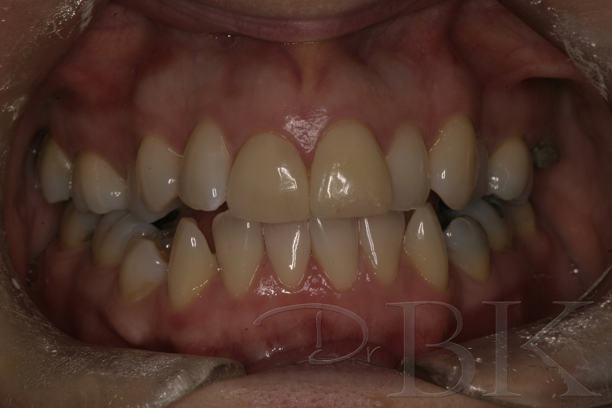 Before Veneers dental veneers dentist reading VENEERS P1 BEFORE copy