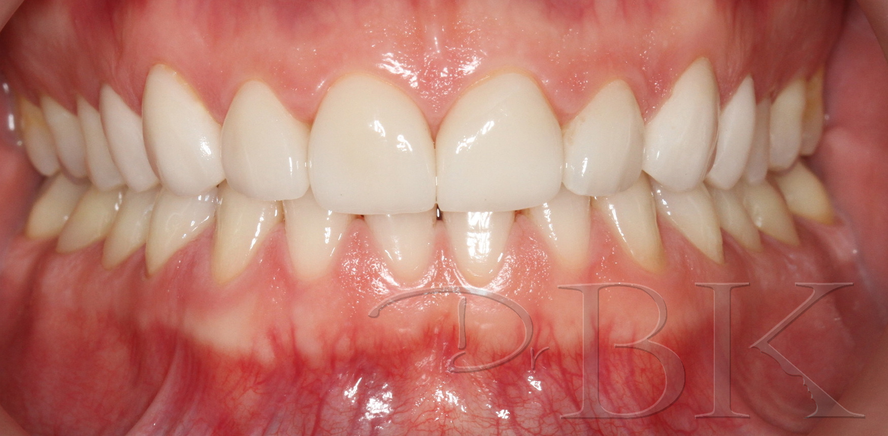 After Veneers dental veneers dentist reading VENEERS PT 2 AFTER copy