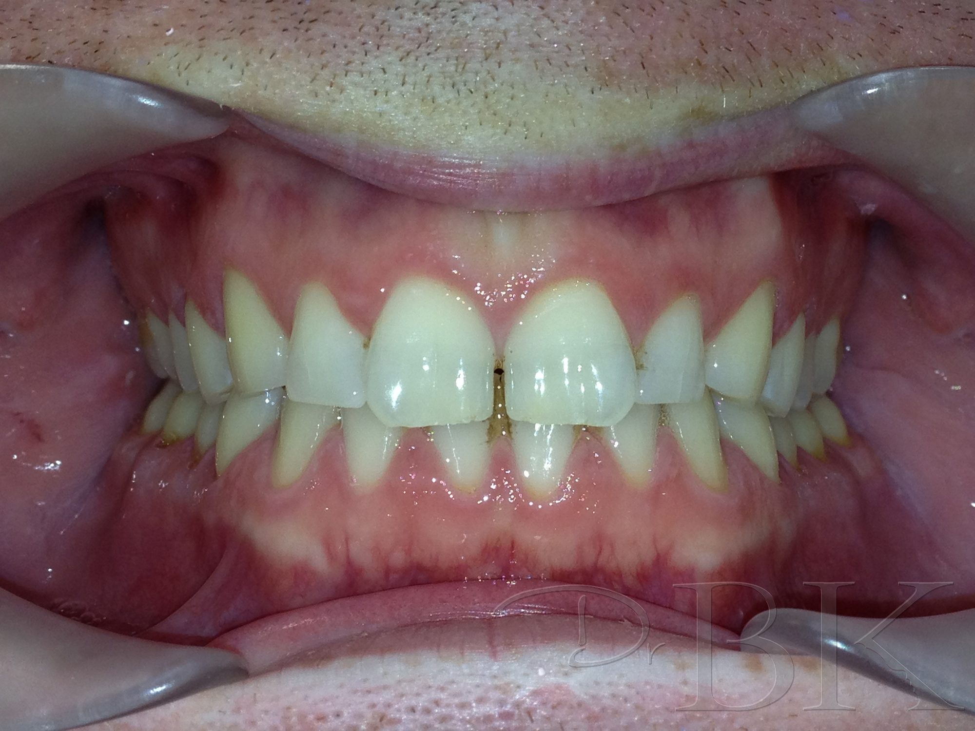 Before Veneers dental veneers dentist reading VENEERS PT 2 BEFORE copy