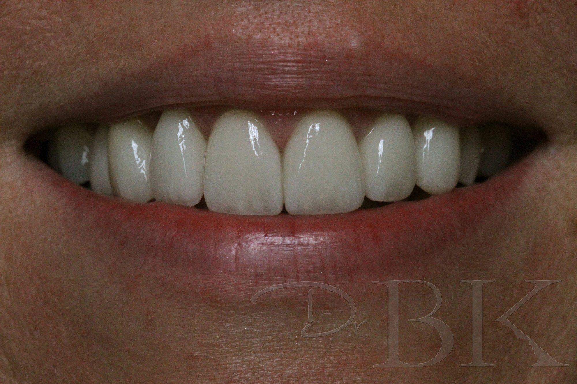 After Veneers dental veneers dentist reading VENEERS PT 5 AFTER copy