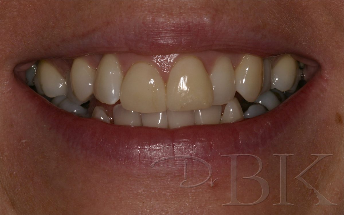 Before Veneers dental veneers dentist reading VENEERS PT 5 BEFORE copy