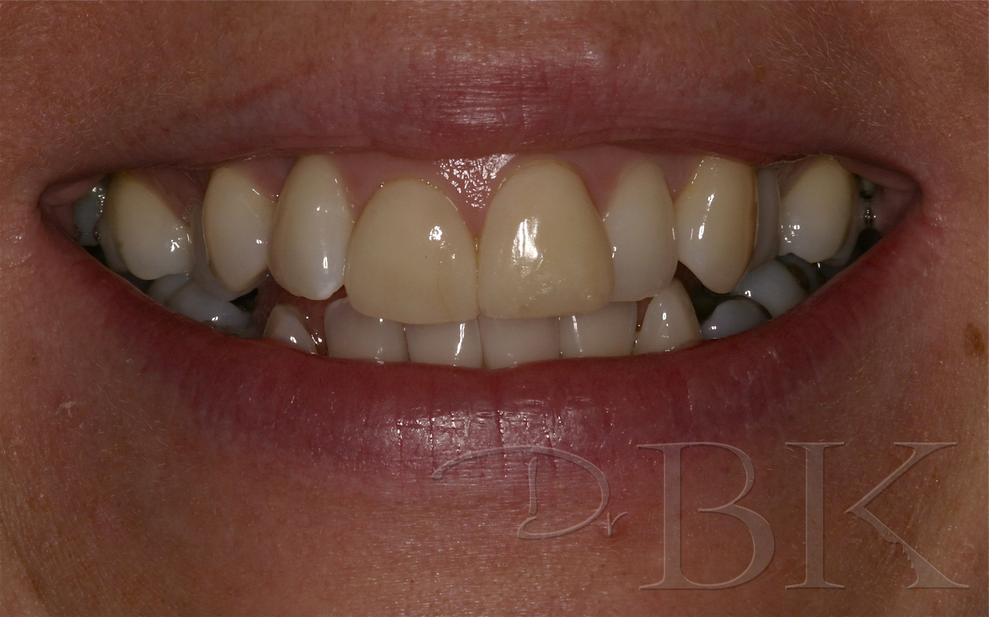 Before Veneers dental veneers dentist reading VENEERS PT 5 BEFORE copy