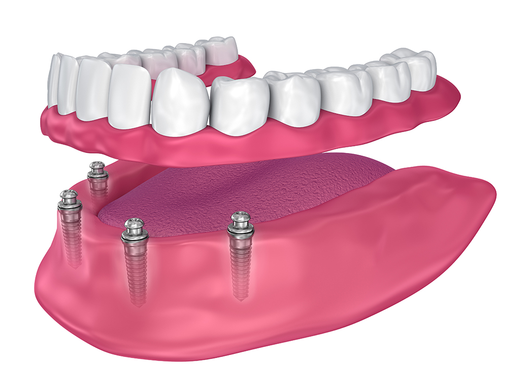 implant retained denture