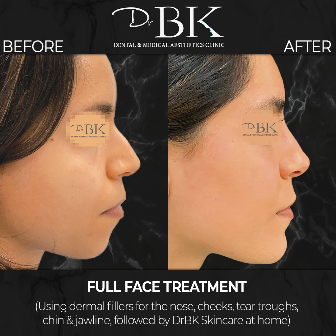 Full Face Treatment: Tear Troughs, Cheeks, Nose, Chin, Jawline & DrBK SKIN