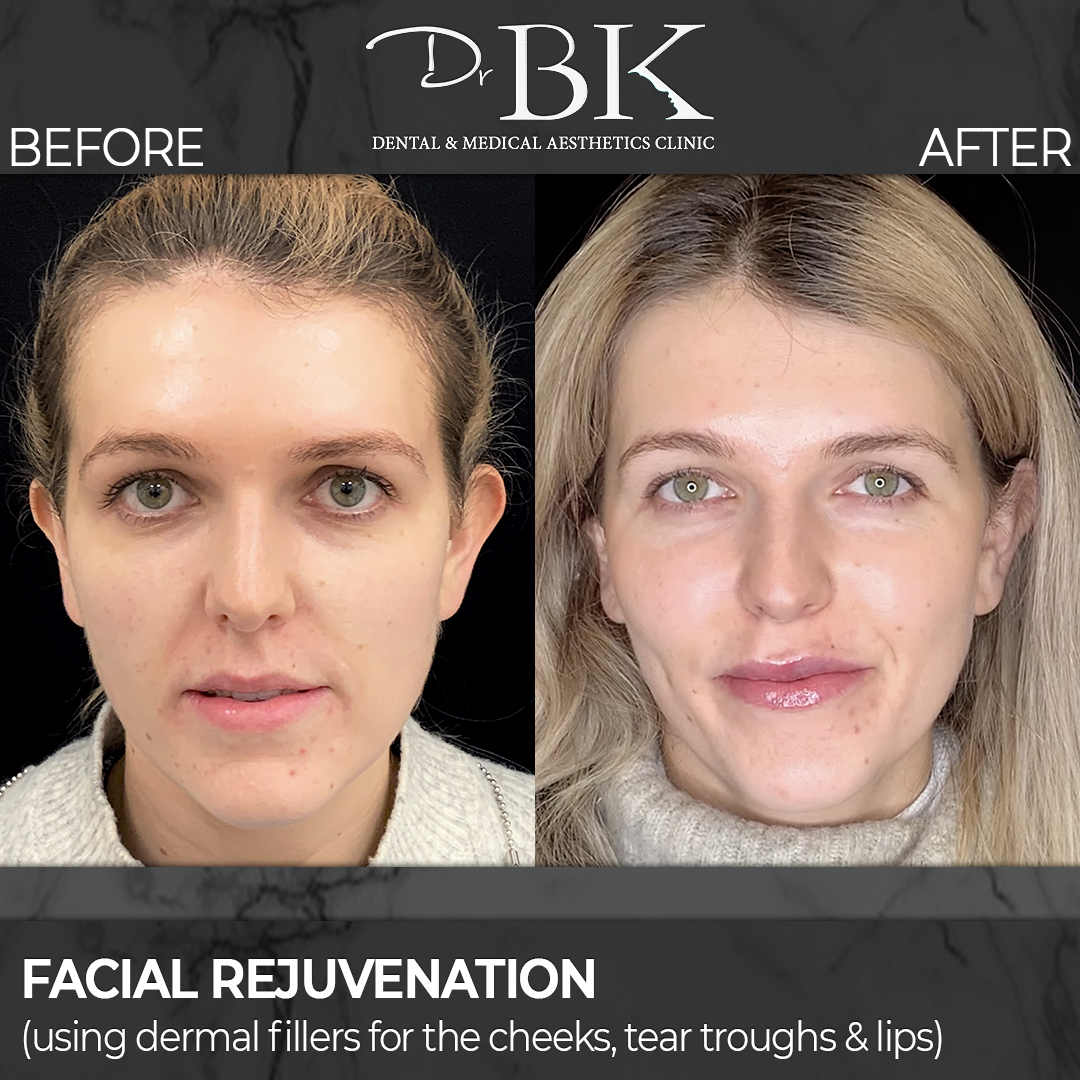 Full Face Rejuvenation: Dermal fillers for the cheeks, tear troughs and lips
