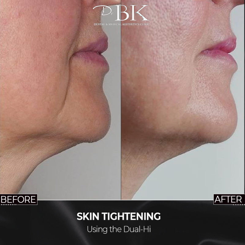 Dual-Hi Advanced Skin Tightening at DrBK