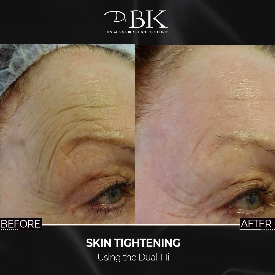 Dual-Hi Advanced Skin Tightening at DrBK