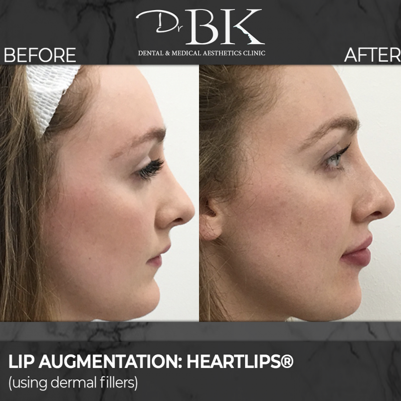 Lip Augmentation: Before & After