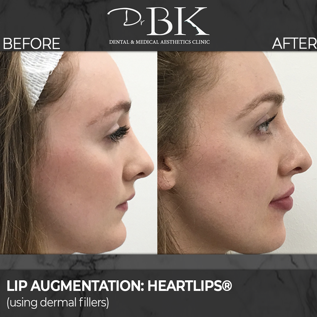Lip augmentation - Heartlips