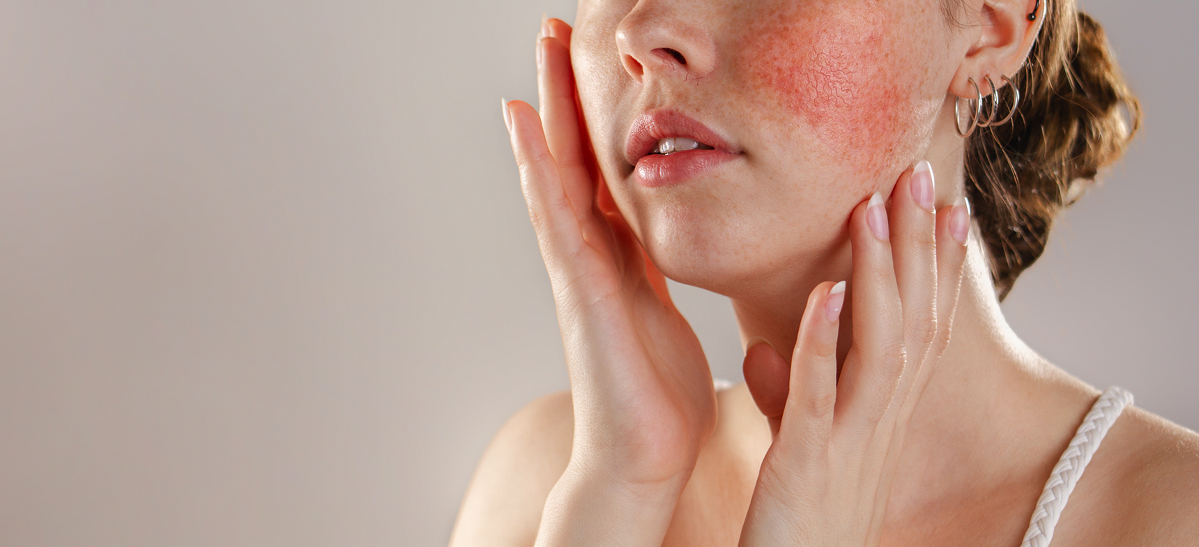 facial thread veins and rosacea treatment