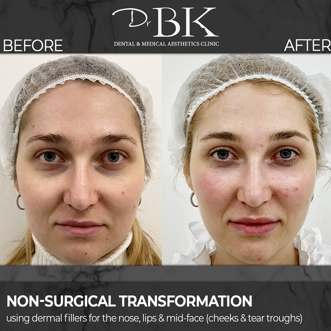 full face rejuvenation and non-surgical rhinoplasty