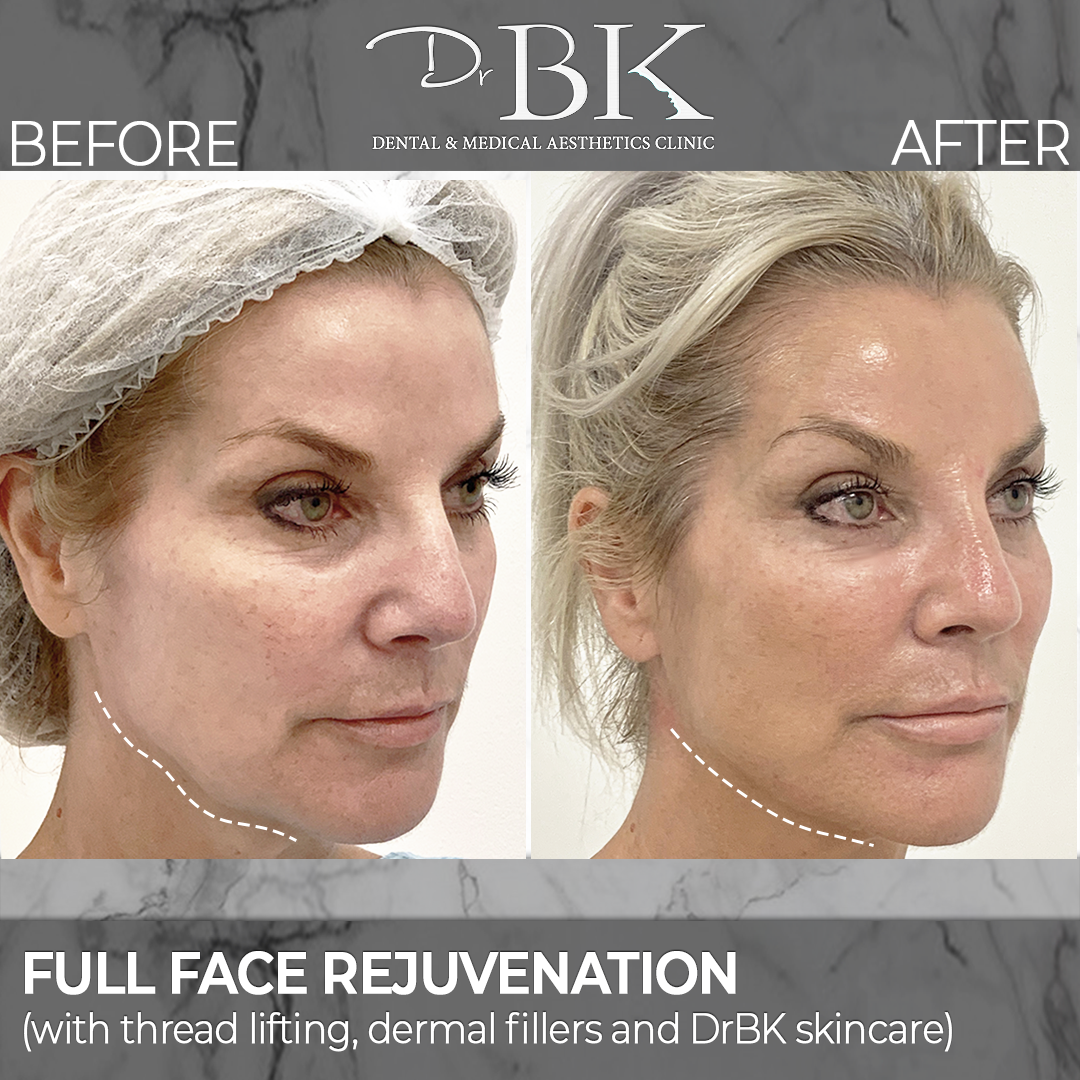 Full Face Rejuvenation: Thread lifting, dermal filler and DrBK SKIN