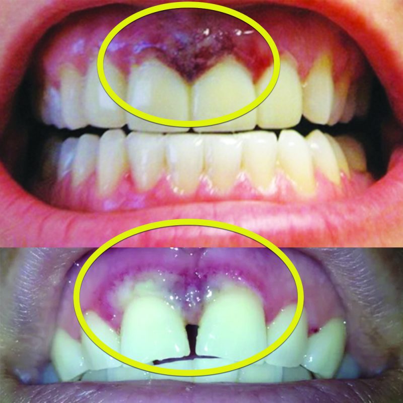 The Dangers of Teeth Whitening